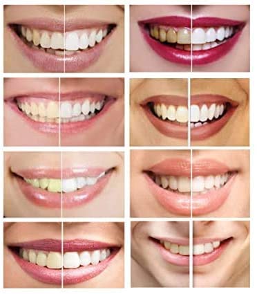 Aplicación precisa del gel para dientes, minimizando contacto con encías.