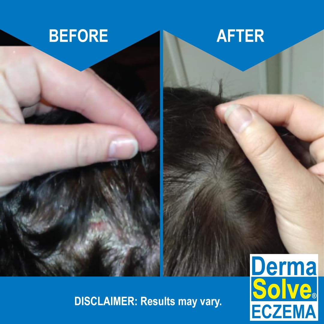 Dermasolve avena coloidal protegiendo el cuero cabelludo.