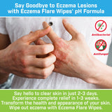 Eczema Flare Wipes: ideal para uso en casa durante periodos de irritación.