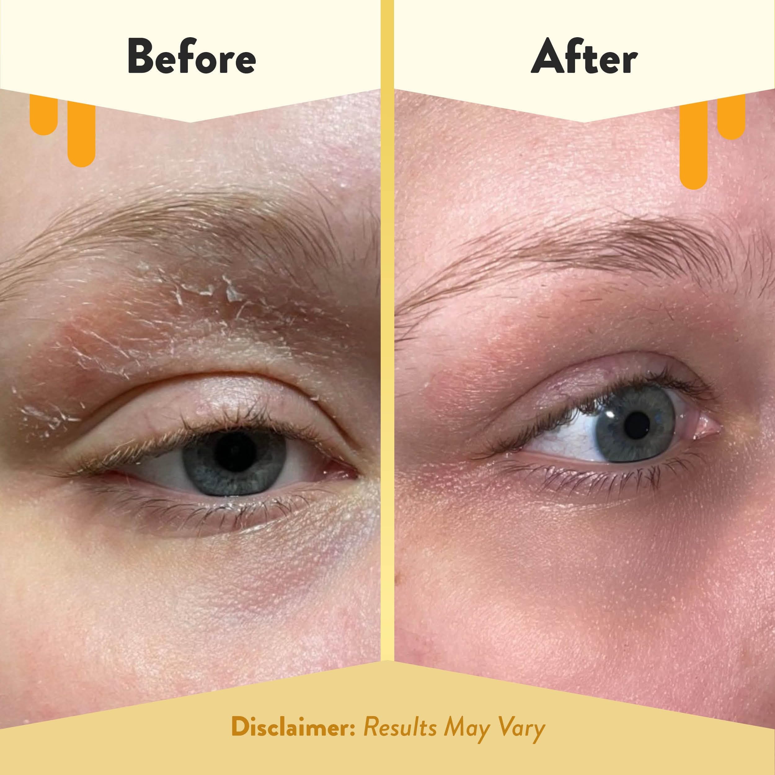 ECZEMA HONEY: ingredientes naturales como avena coloidal y miel para calmar la irritación