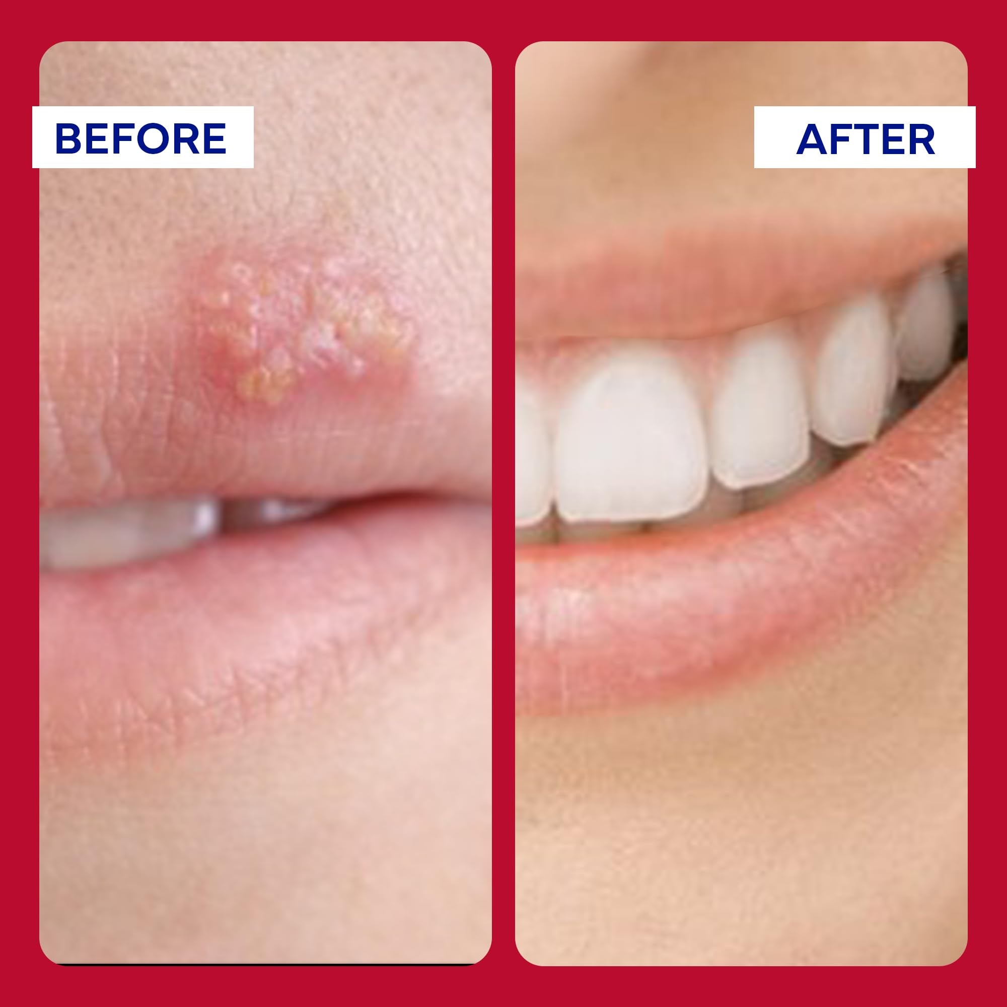 EMUAIDMAX Ungüento, herpes labial, calma molestias y áreas cercanas.