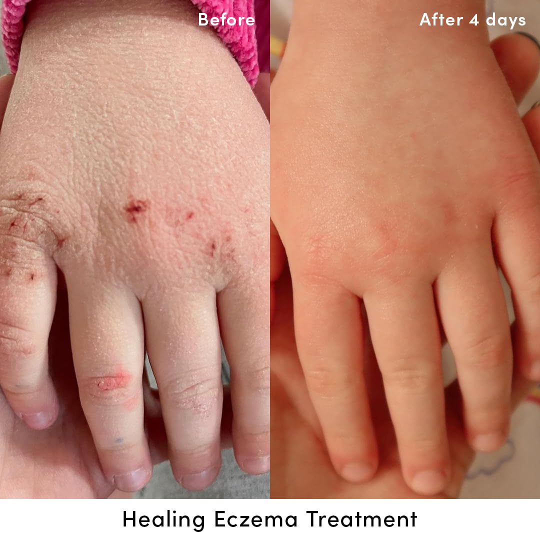 Evereden crema eczema manos-aplicación, cuidado suave para manos con sequedad.