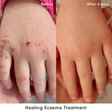 Evereden crema eczema manos-aplicación, cuidado suave para manos con sequedad.