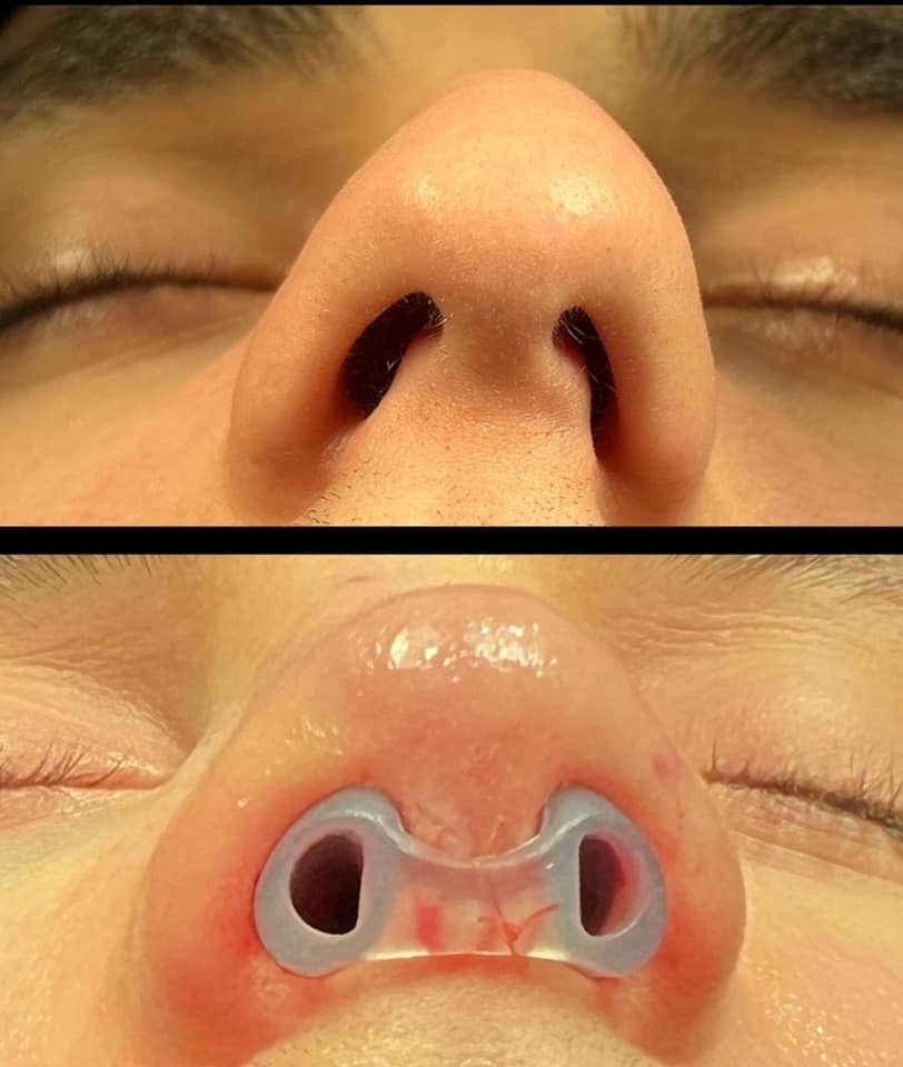 footlıne: soporte nasal para modelar la forma tras cirugía