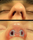 footlıne: soporte nasal para modelar la forma tras cirugía