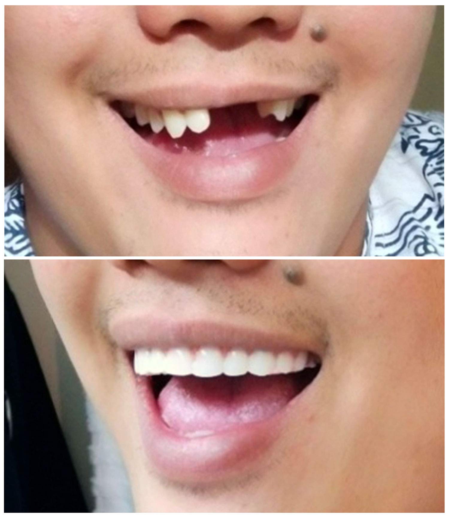 Instant Smile Comfort Fit Flex muestra un perfil delgado que reduce interferencias al hablar.