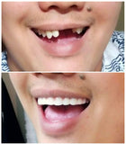 Instant Smile Comfort Fit Flex muestra un perfil delgado que reduce interferencias al hablar.