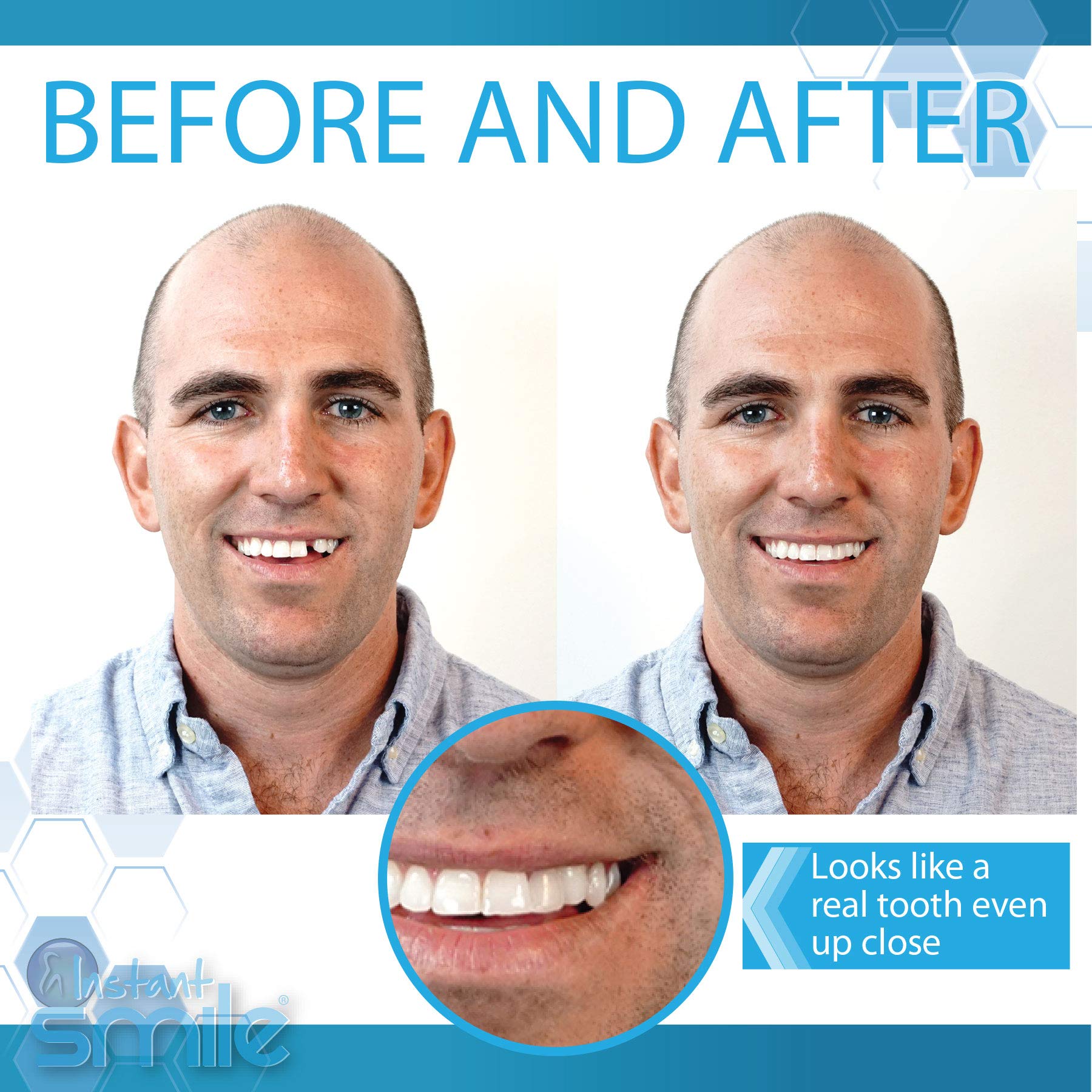 Instant Smile cuatro tonos dentales para emparejar color y sonrisa.