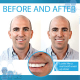 Instant Smile cuatro tonos dentales para emparejar color y sonrisa.