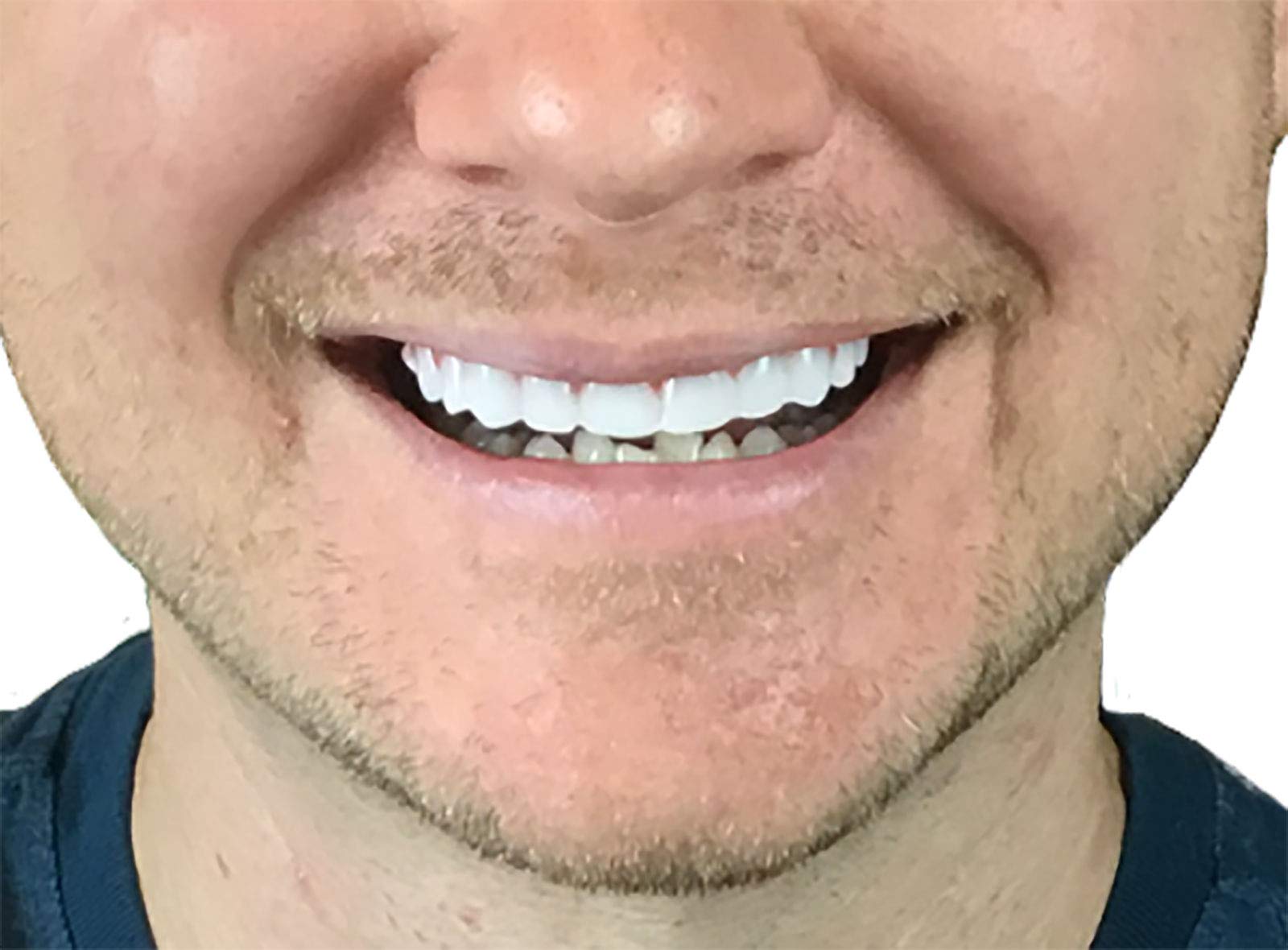 Instant Smile Flex 2pk, uso rápido para una sonrisa mejor en minutos.
