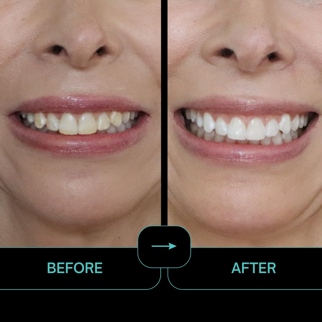 IntelliWHiTE ProStrips: sonrisa más brillante tras uso continuo.