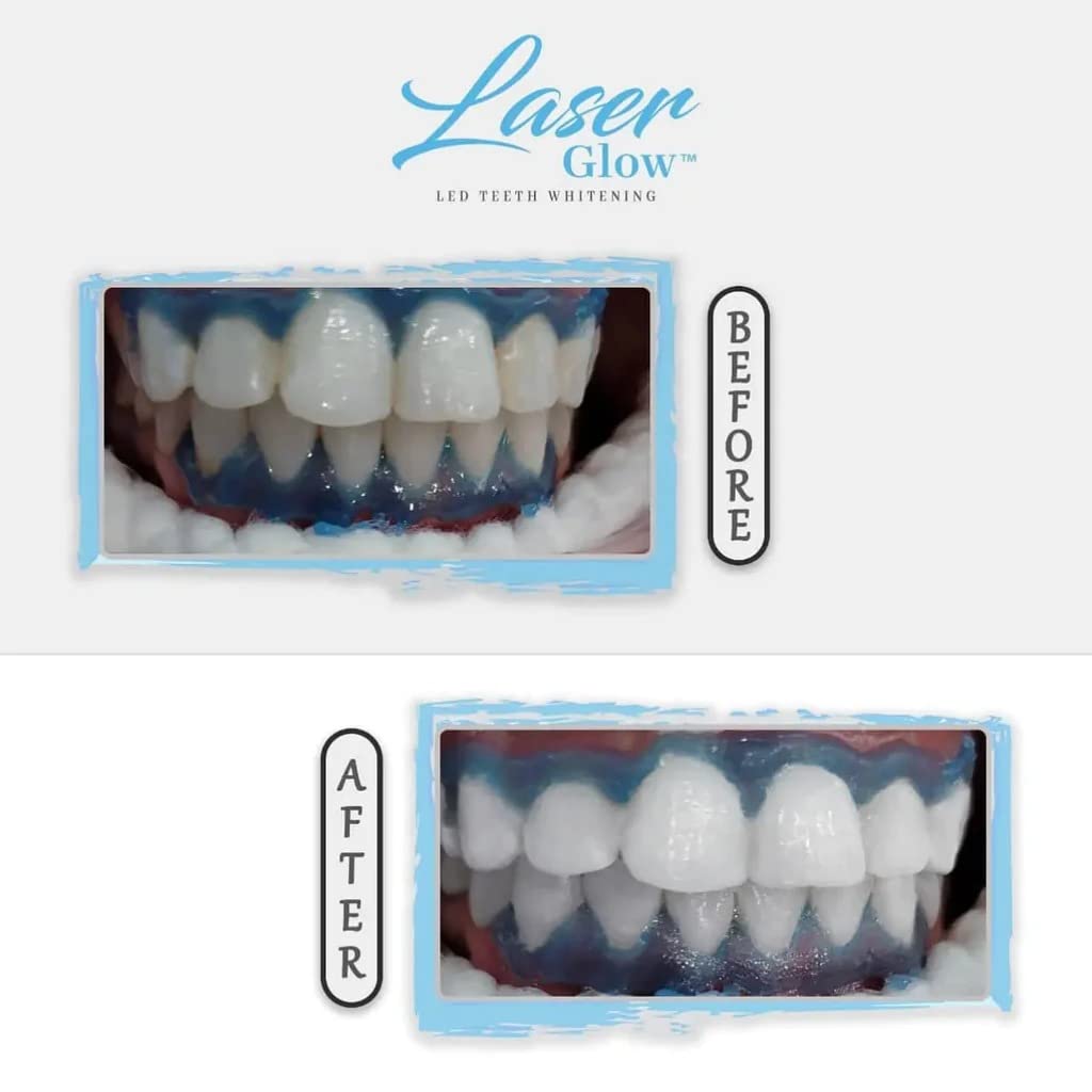 Laser Glow kit completo de blanqueamiento dental para resultados visibles.