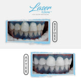 Laser Glow kit completo de blanqueamiento dental para resultados visibles.