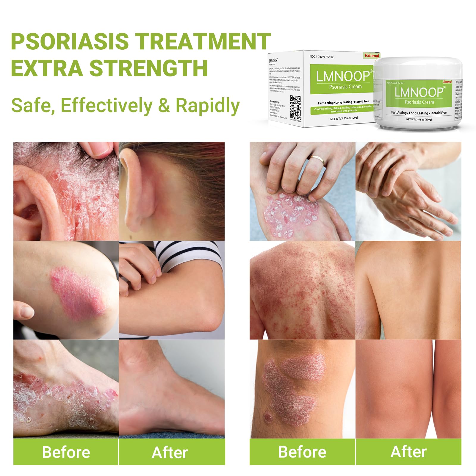 LMNOOP crema psoriasis cuero cabelludo alivio suave
