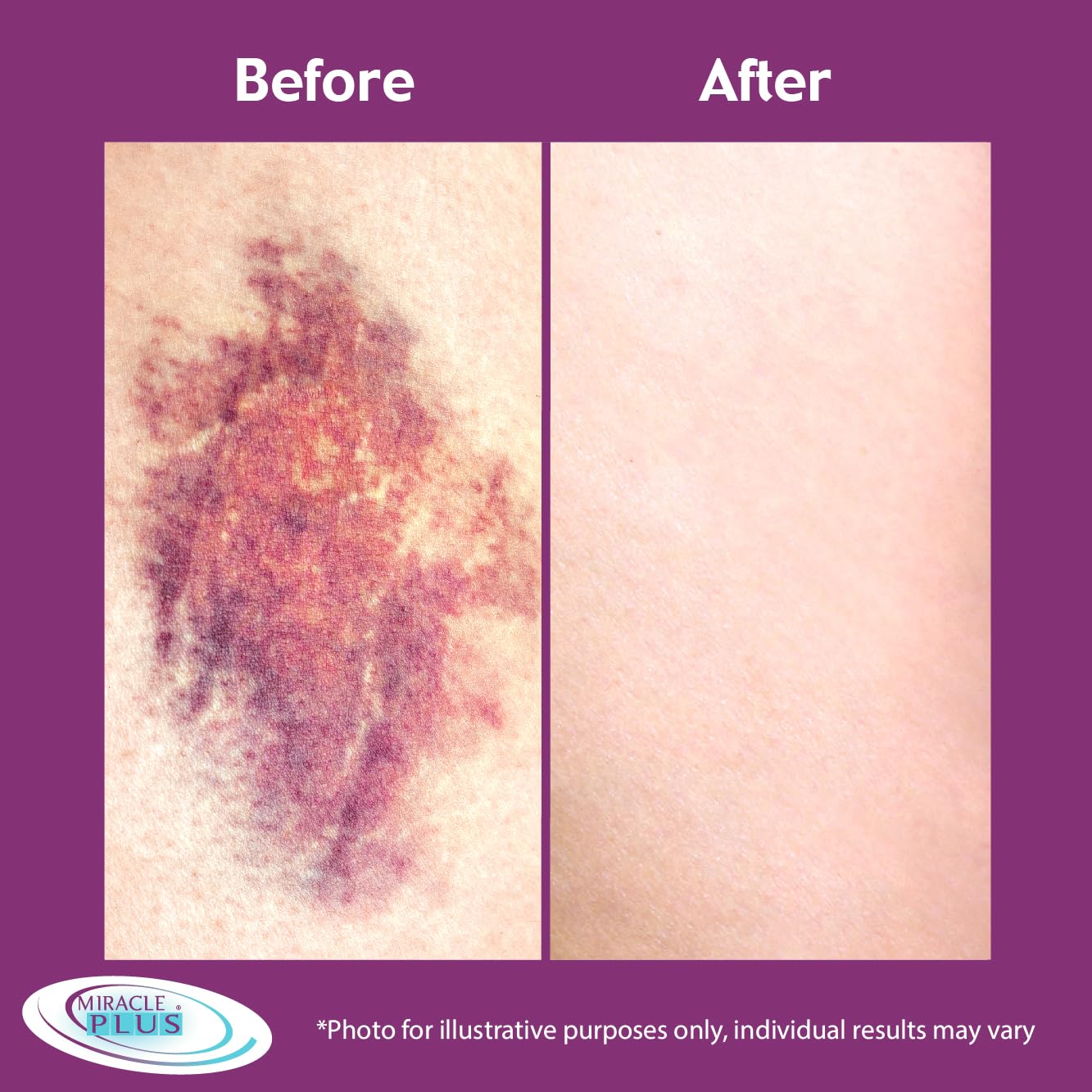 Miracle Plus Arnica contiene Vitamina K para soporte de la piel
