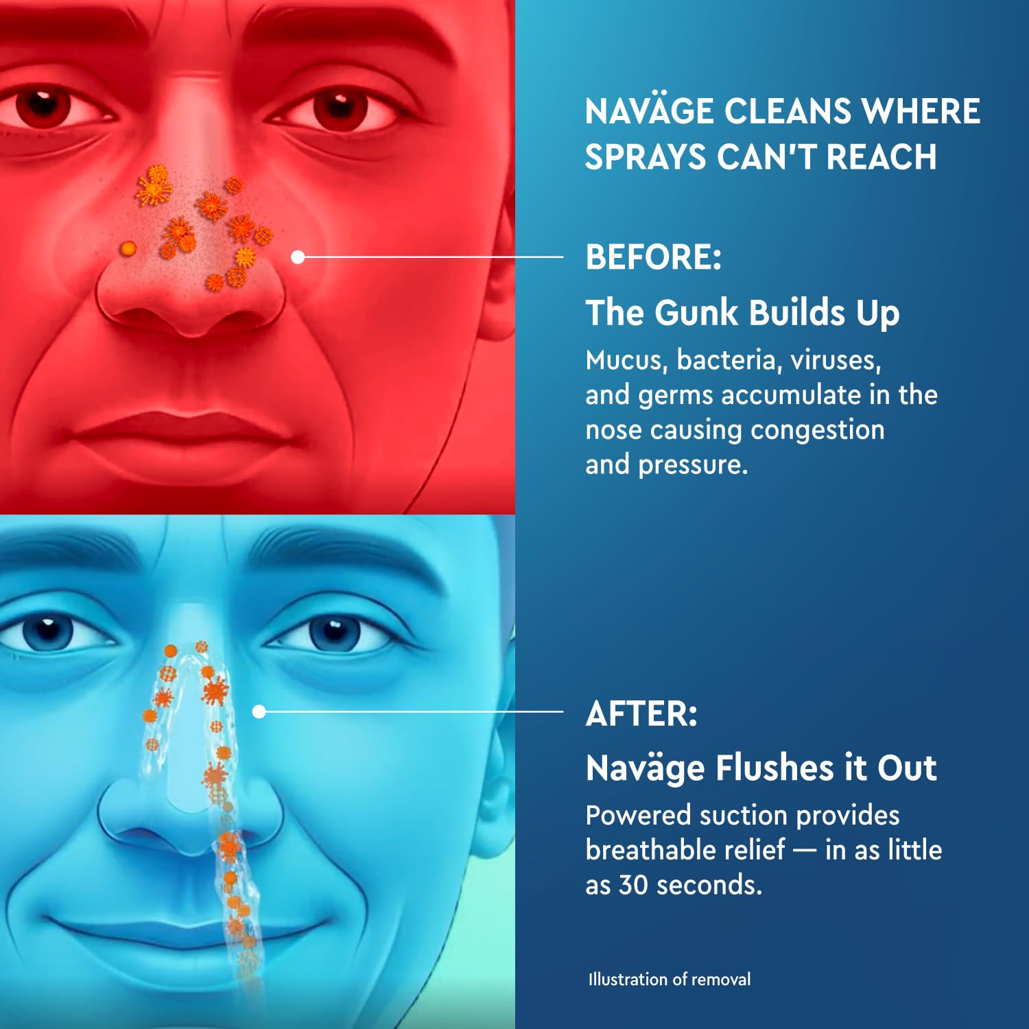 Navage Paquete de Inicio, experiencia diaria de higiene nasal para comodidad.