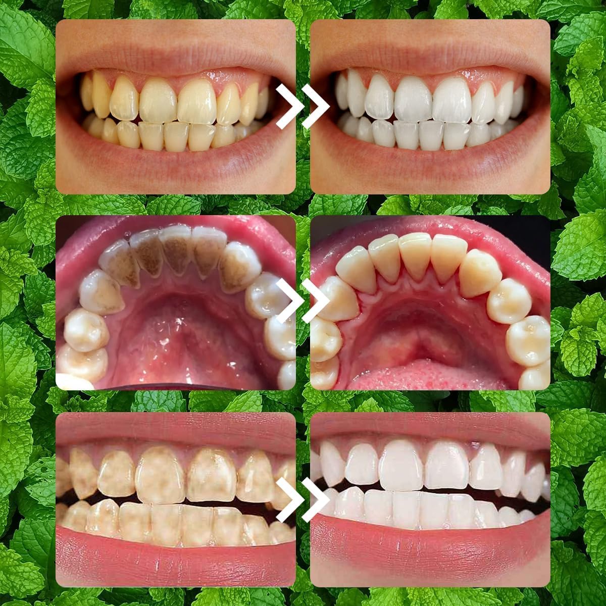 Oprtuisi remineralización de dientes para una sonrisa saludable.