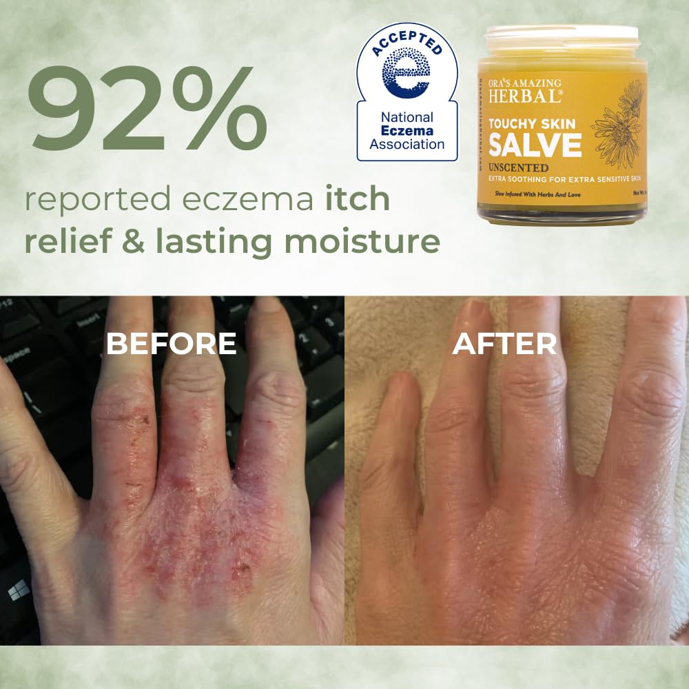 Ingredientes Calendula en Touchy Skin Salve para irritaciones leves.