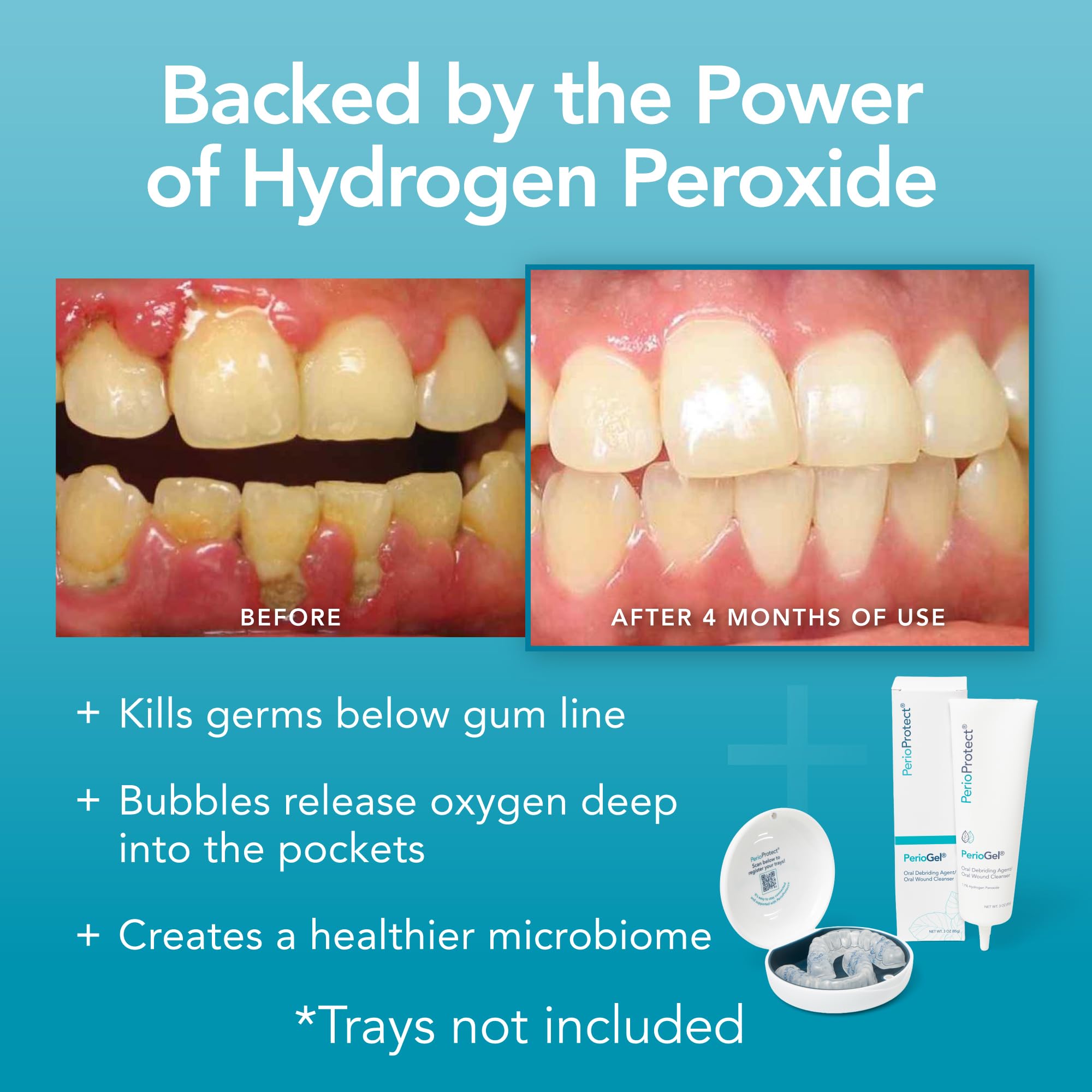 Aplicación en casa con Perio Tray y gel debajo de la línea gingival.