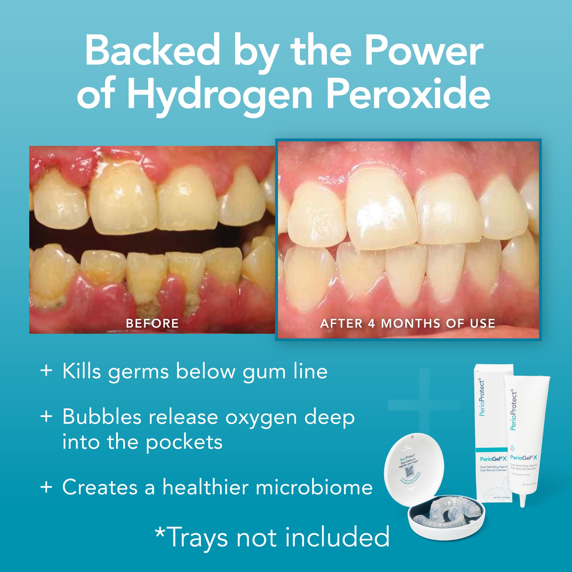 PerioGelX: uso no invasivo para cuidado periodontal diario.