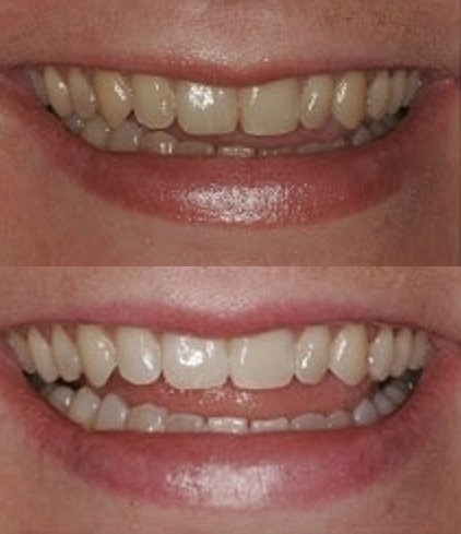 ProDental paquete de 60 tratamientos para sonrisa más brillante