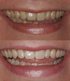 ProDental paquete de 60 tratamientos para sonrisa más brillante