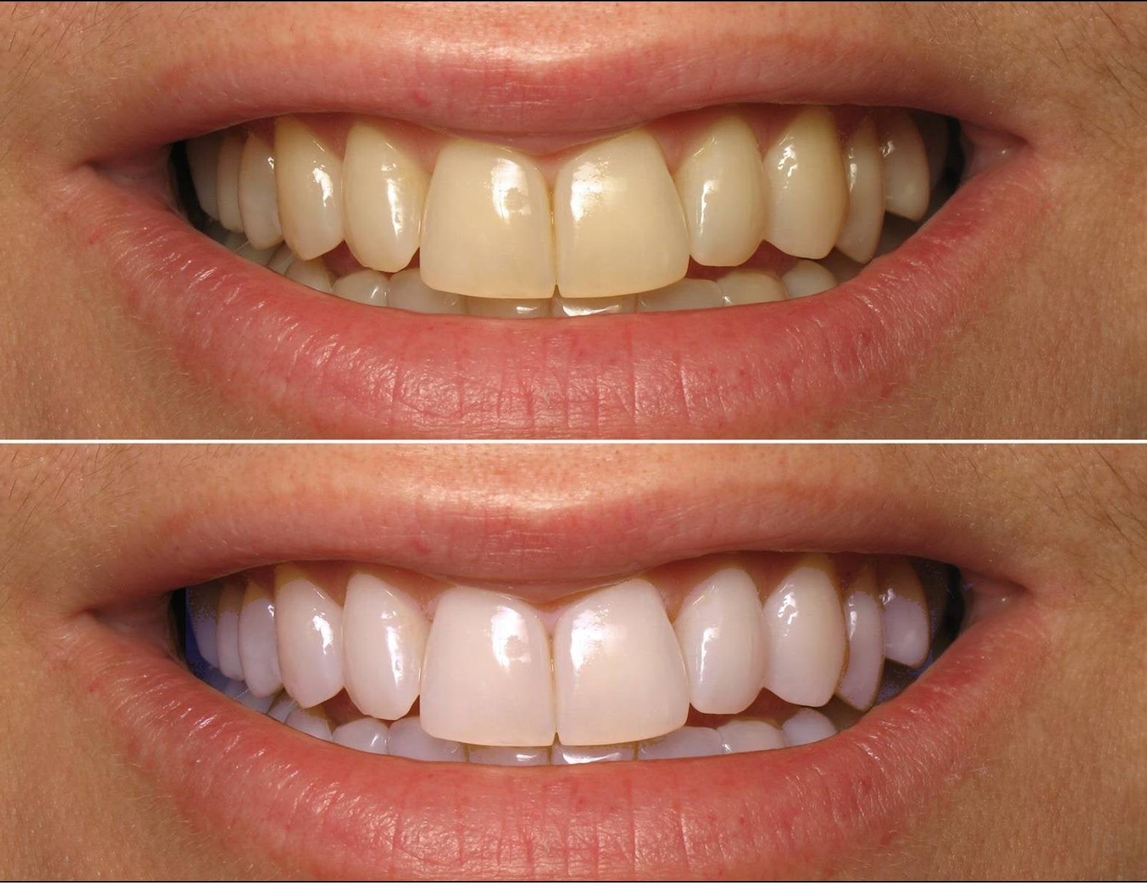 ProDental peroxido de carbamida 35% en 3 ml para eliminar manchas