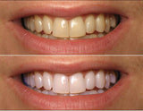 ProDental peroxido de carbamida 35% en 3 ml para eliminar manchas