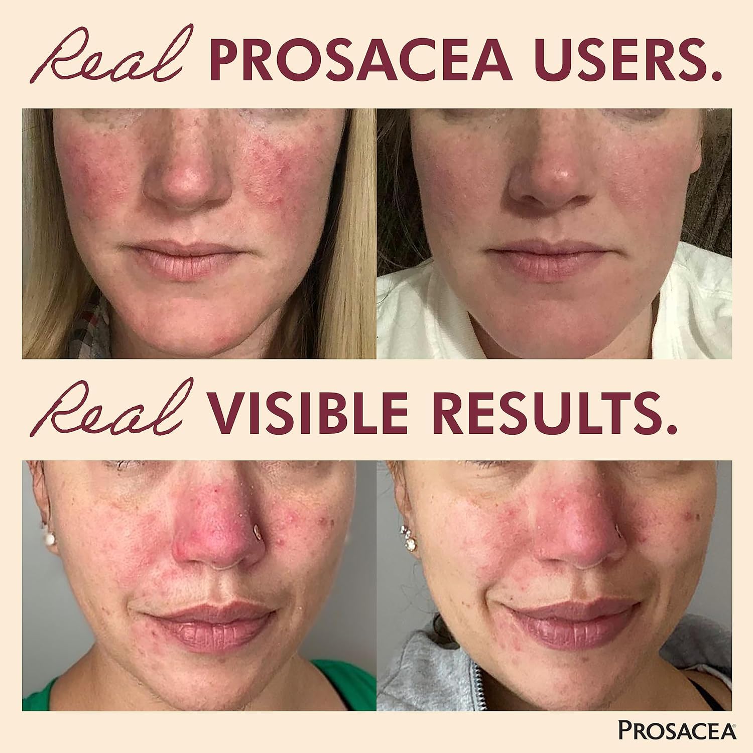 Aplicación facial de Prosacea para alivio rápido de irritación.