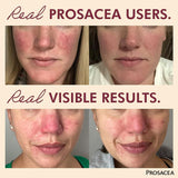 Aplicación facial de Prosacea para alivio rápido de irritación.