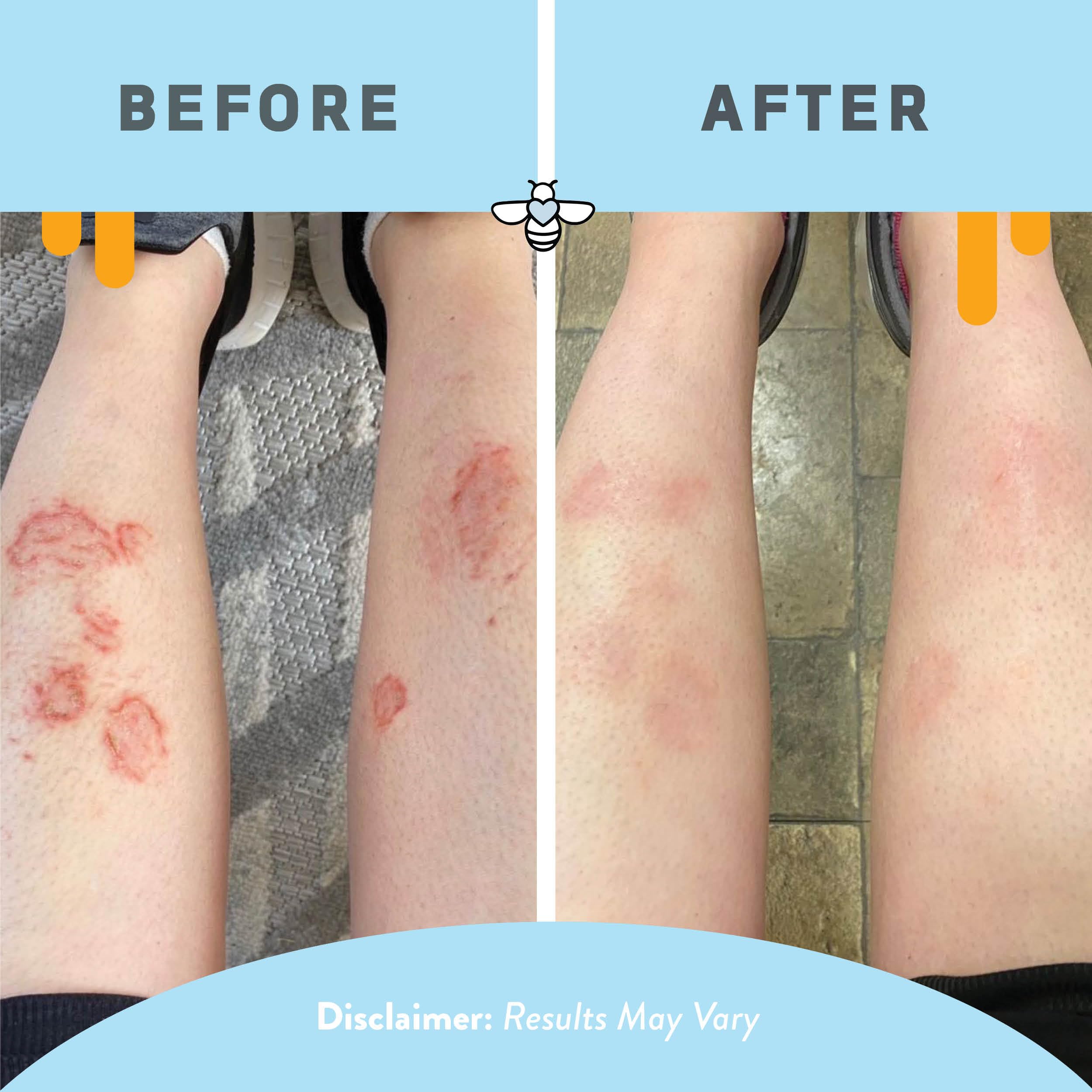 PSORIASIS HONEY ingredientes naturales: miel y aceite de uva para hidratación.