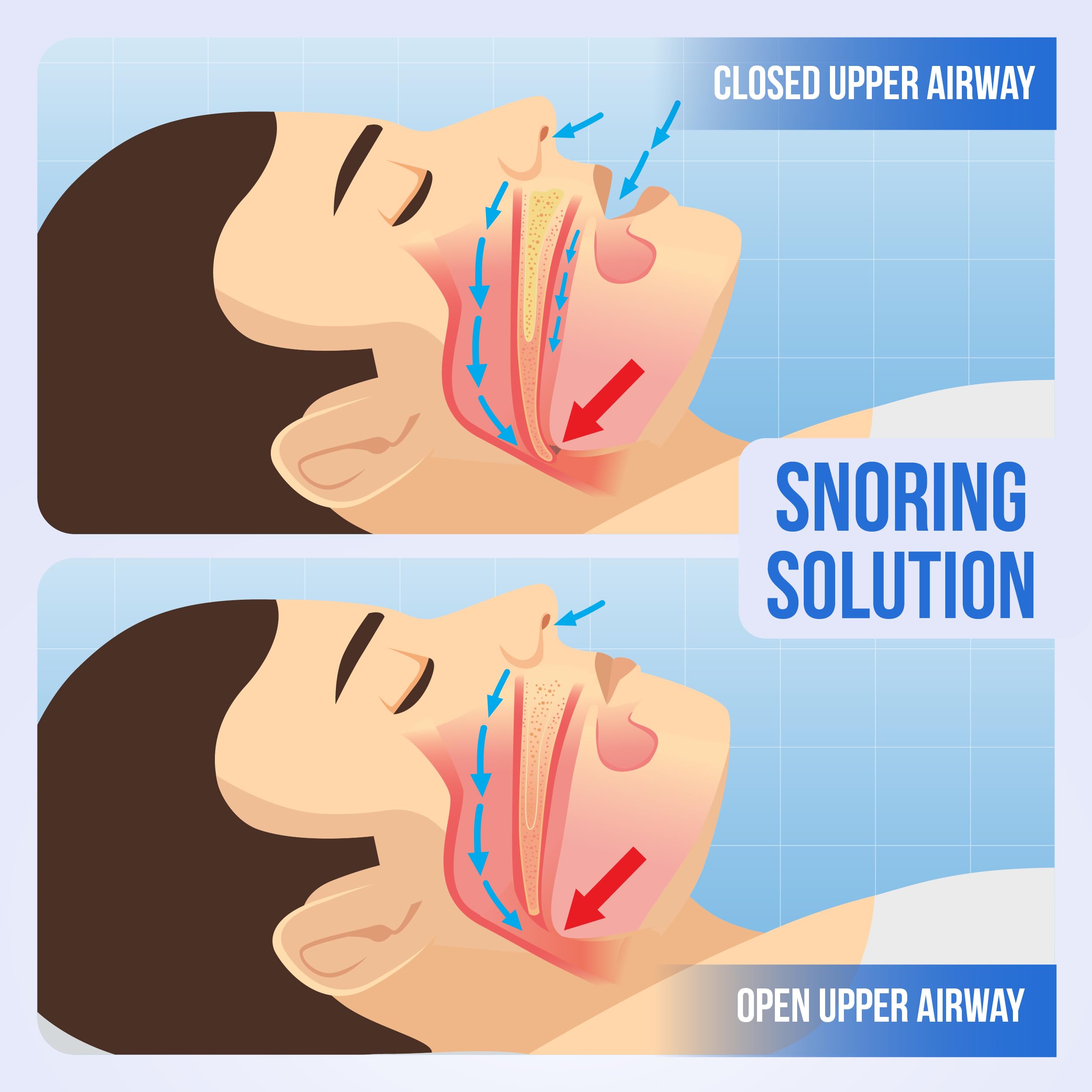 SnoreGuard lavado y cuidado: limpieza sencilla y secado rápido