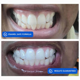 Snow DiamondSeries Strips dientes brillantes tras blanqueamiento suave.