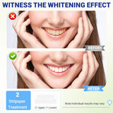 Sundpik tiras blanqueamiento dientes baja irritación protege el esmalte durante el tratamiento