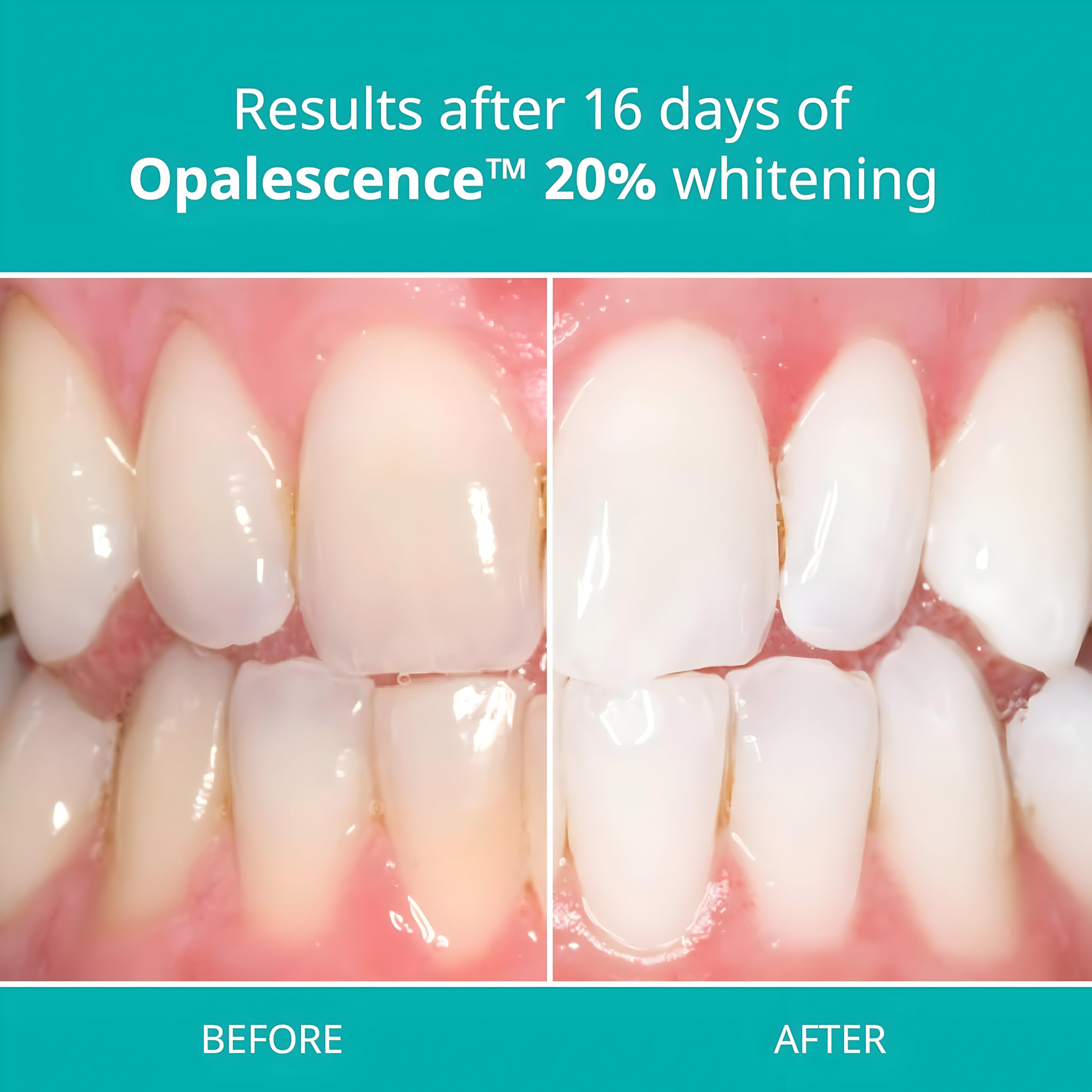 ULTRADENT Opalescence PF gel viscoso: evita migración y mantiene la bandeja en su sitio